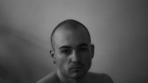 Man with male pattern baldness