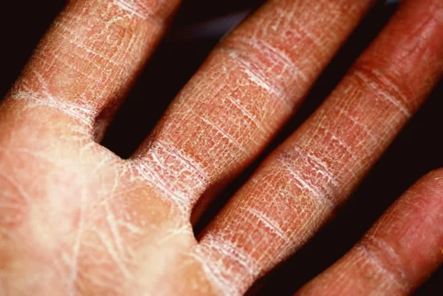 Dry skin on hands